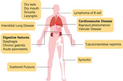 Frontiers Pathogenesis And Treatment Of Sjogren S Syndrome Review   1127417 Thumb 400 